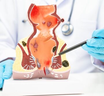A human anatomy medical model used by healthcare professionals to demonstrate the anatomy of the rectum.