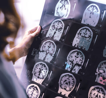 A person holding a black-and-white medical film sheet containing multiple coronal (front-to-back cross-section) magnetic resonance imaging (MRI) scans of a human brain, showing standard anatomical structures of the cerebral hemispheres, ventricles, and brainstem.